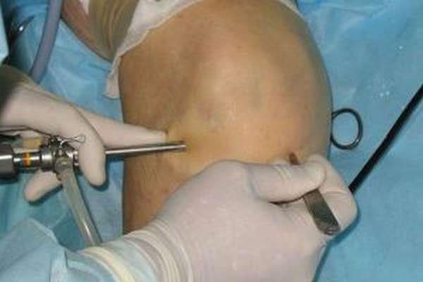 Синовэктомия сустава колена